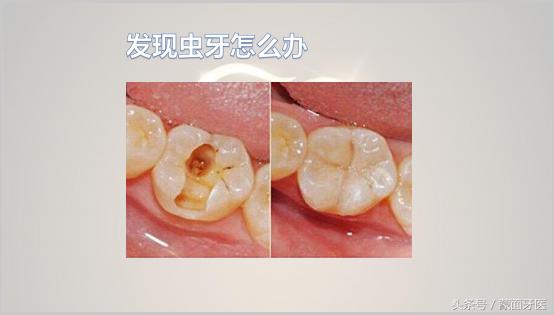 关爱牙齿预防虫牙从小做起,儿童漱口水能够预防虫牙