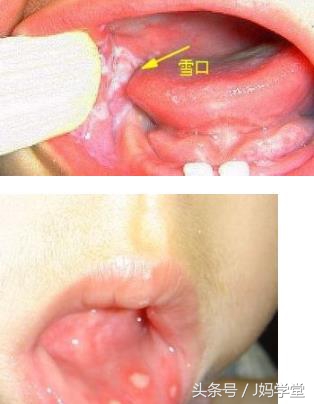 婴儿鹅口疮的症状及治疗方法,宝宝鹅口疮的症状识别及防治办法