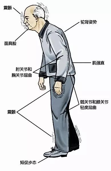 「行家讲健康」康复中心戚成奎主任：手会抖是怎么一回事？