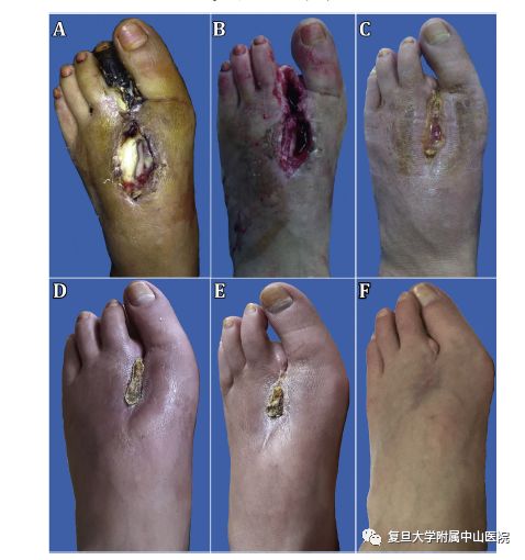 干细胞技术竟然能够“生死肉骨”？！中山医院自体干细胞移植治疗难治性重度肢体缺血