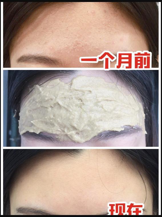 闭口消不下去,闭口挤不出来反而肿了多久能好