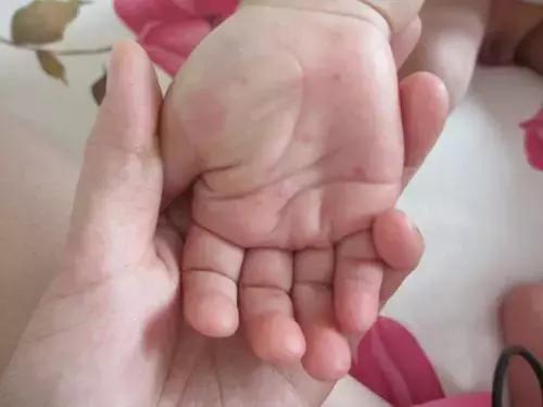 手足口疫苗接种副功能,打了手足口疫苗腹泻怎么办