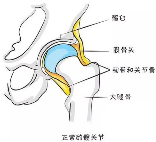 什么是成人髋关节发育不良,成人髋关节发育不良贴吧