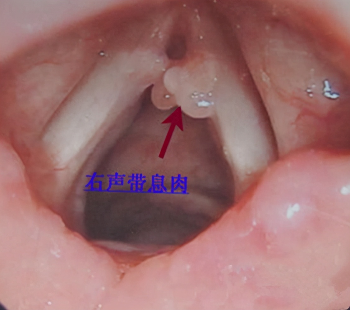 当心！29岁女子忽然无法发声，原来是喉咙里长了块肉