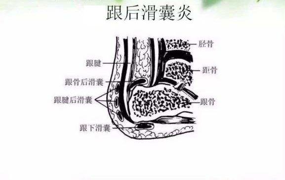 足后跟底踩下去痛是什么原因,早上起床足后跟痛是什么原因