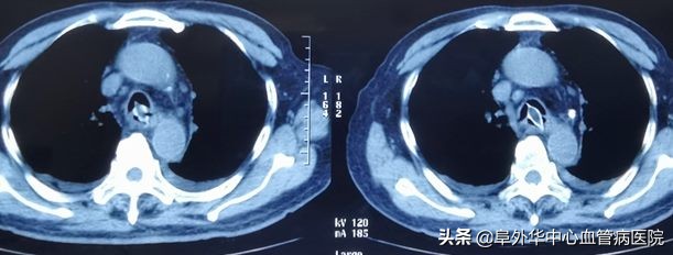 八旬老人误吞枣核肠,老人误吞枣核怎么化解