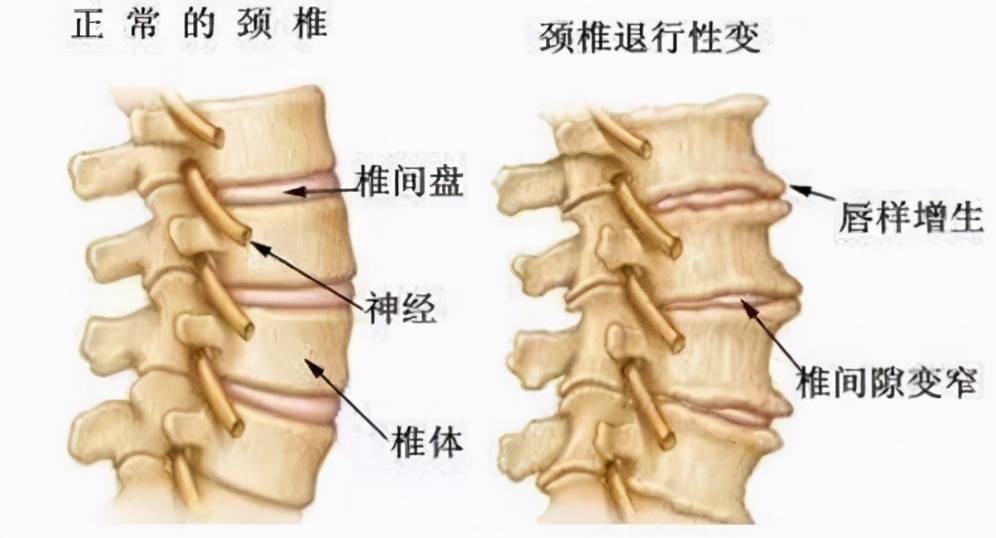 腰椎骨刺骨质增生怎么治疗,颈椎骨刺骨质增生的治疗方法