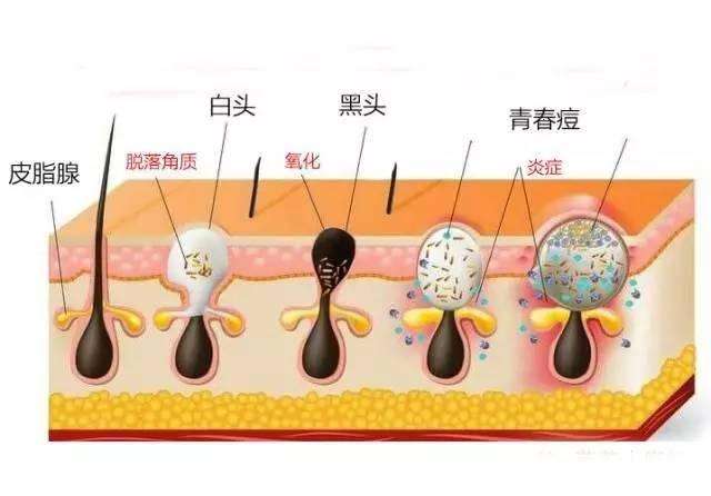 男士毛孔大黑头多用什么护肤品,收缩毛孔去黑头粉刺的护肤品排行