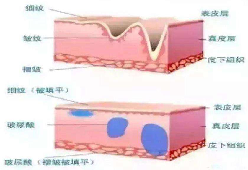 3个经典手法轻松告别泪沟,各个方法消除泪沟视频