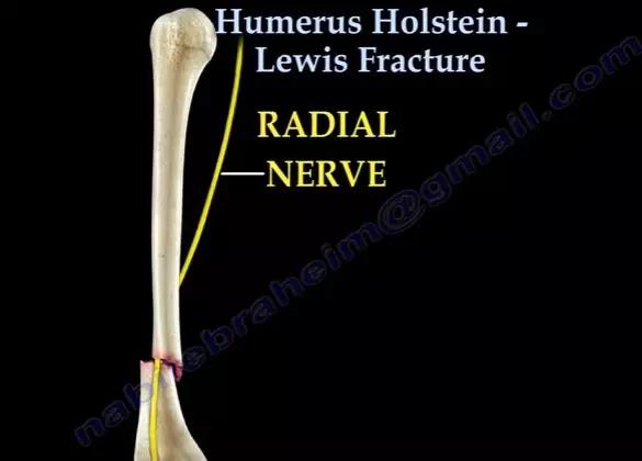 特殊骨折类型,特殊骨折体征