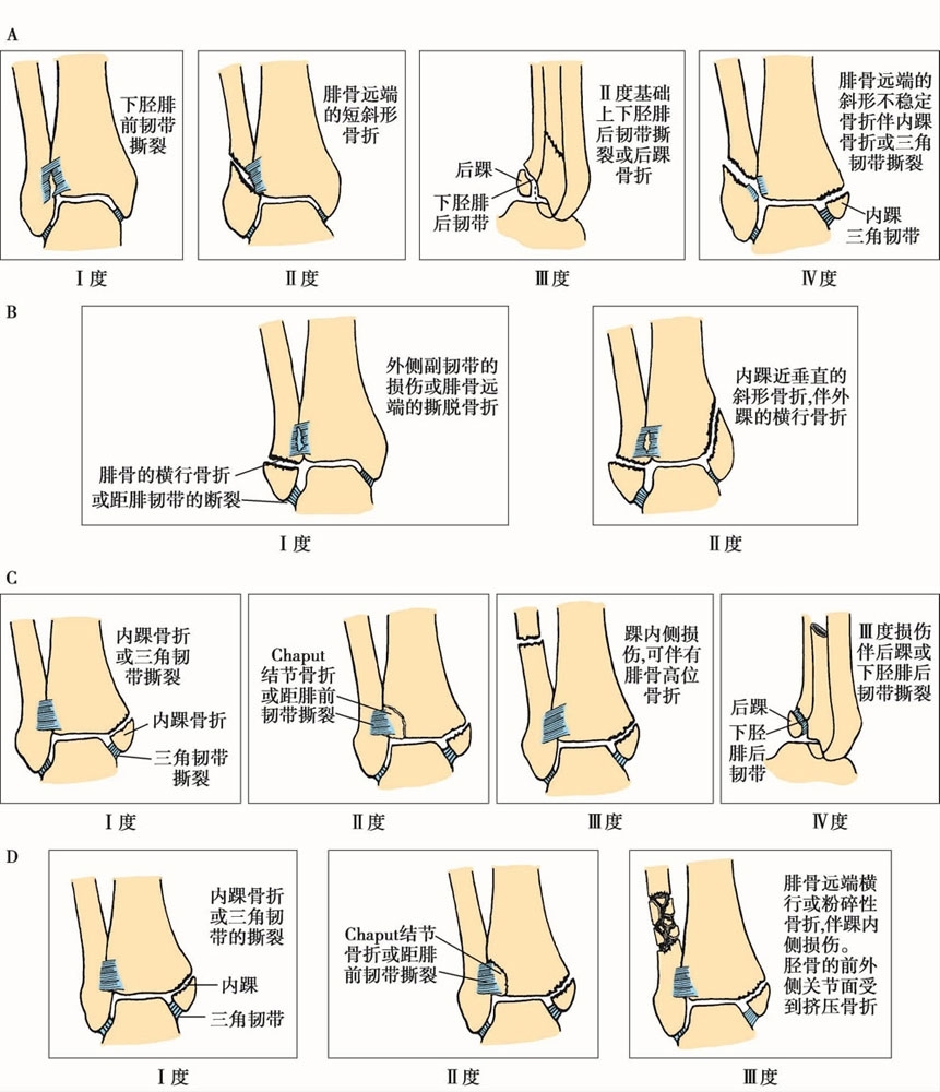 踝关节骨折恢复训练,踝关节骨折几级伤残