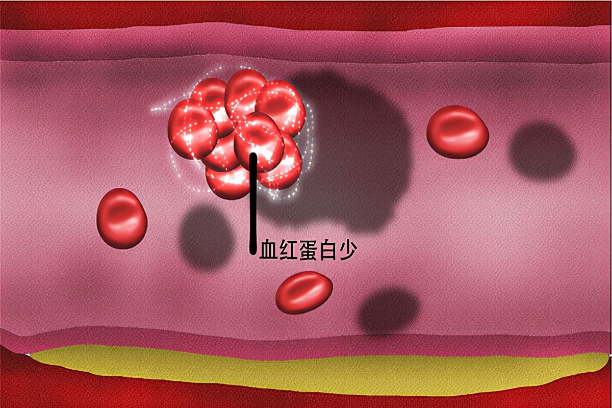 当更年期遭遇高血压教你轻松应对,更年期高血压应怎样对待