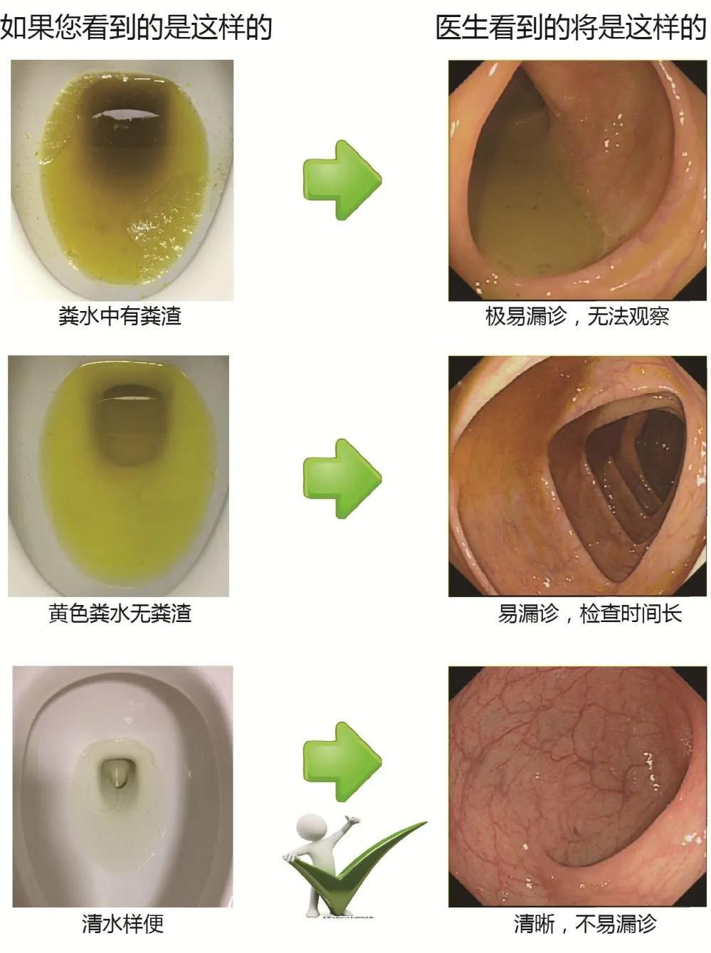 不这样准备肠道，这次肠镜就白受罪了