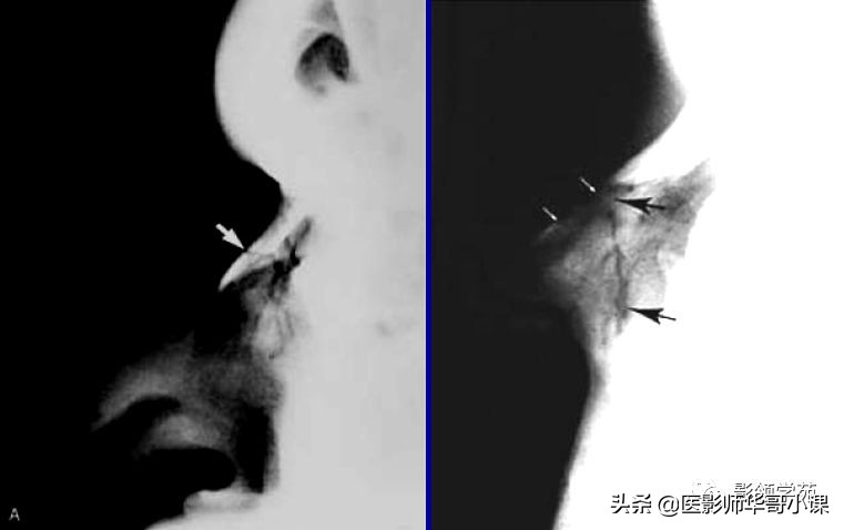 「鼻骨彩图」鼻骨CT解剖及骨折影像学诊断