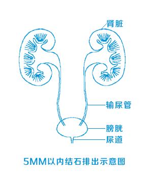 输尿管结石快要掉下来的前兆疼痛,得了结石不治疗会怎样