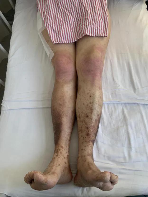 男子脚骨折去医院,男子脚伤手术后仍一瘸一拐