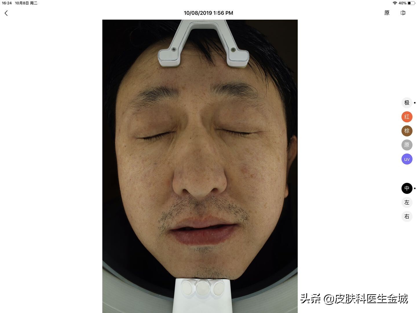 皮肤美容医生超皮秒全体验,皮肤美容医生超皮秒