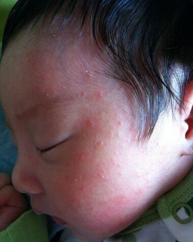 婴幼儿湿疹是什么原因造成的,婴幼儿湿疹是什么原因引起的