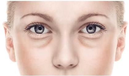 45岁女人合适做哪种祛眼袋方法,生姜祛眼袋的正确方法