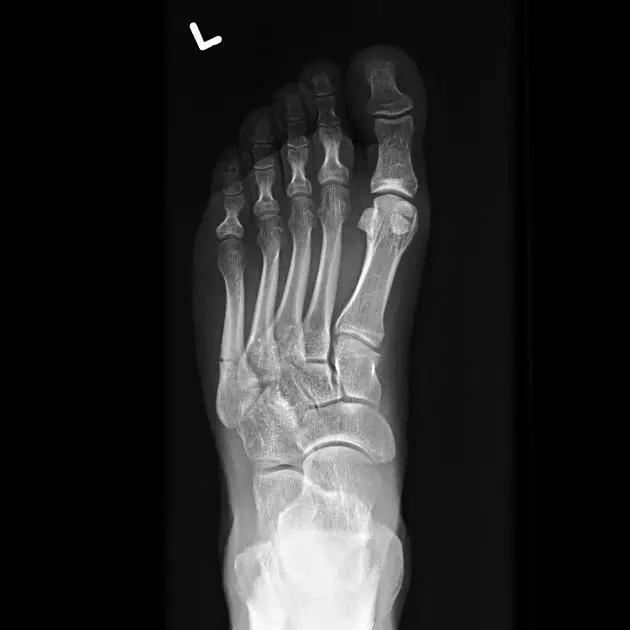 特殊骨折类型,特殊骨折体征