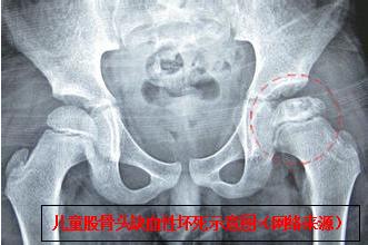 小孩髋关节脱臼复位手法视频,宝宝髋关节脱位能够正骨复位吗