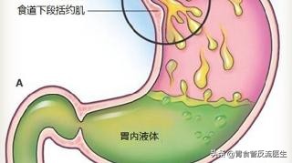 胃酸是怎么来的，为什么我感觉胃里是酸的，嘴巴也是酸的？