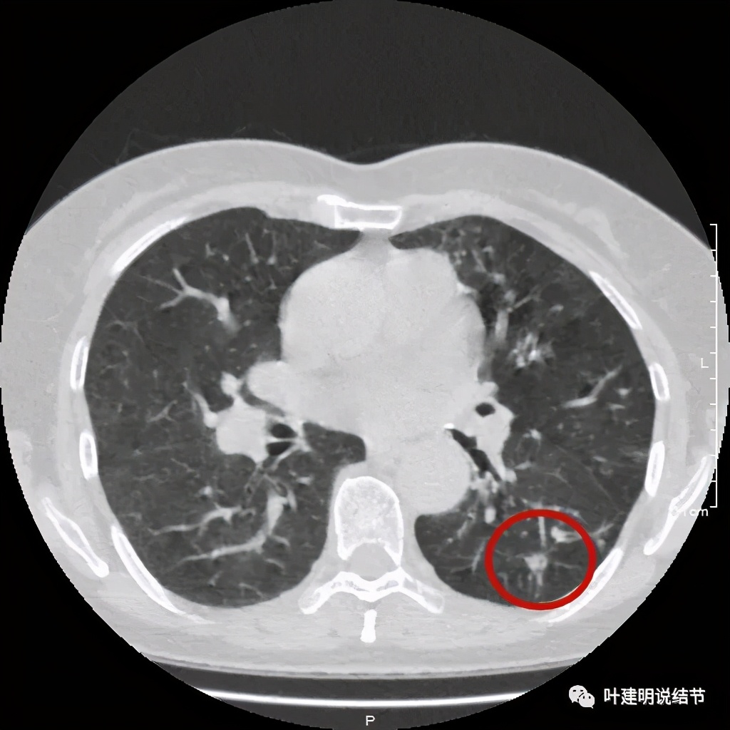 这样的实性结节伴小空洞会是肺癌吗？
