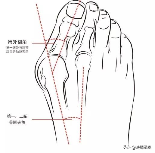 拇指长歪了？别慌！常德市第一中医医院行家帮您改“邪”归正