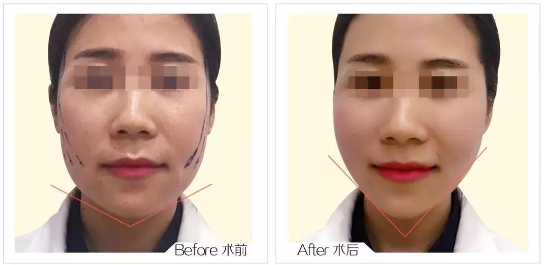 线雕加玻尿酸能够保多长时间,玻尿酸加线雕隆鼻能半永久吗