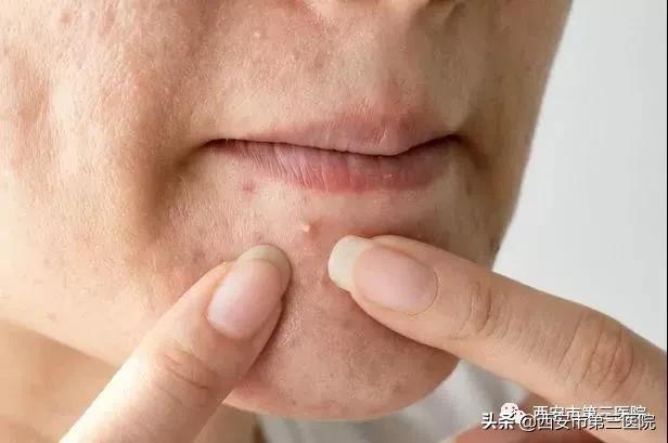脸上全是痘真正有效的办法,脸上长小痘痘不疼不痒是什么痘