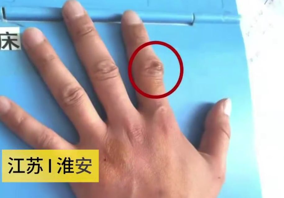 成年人焦虑症咬手指甲,焦虑症下意识咬手