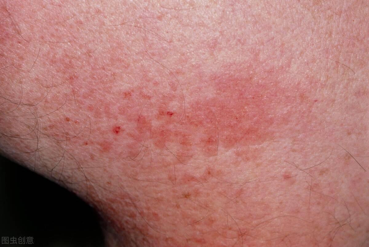 靶向药物引起腹泻中医治疗,靶向药所致腹泻