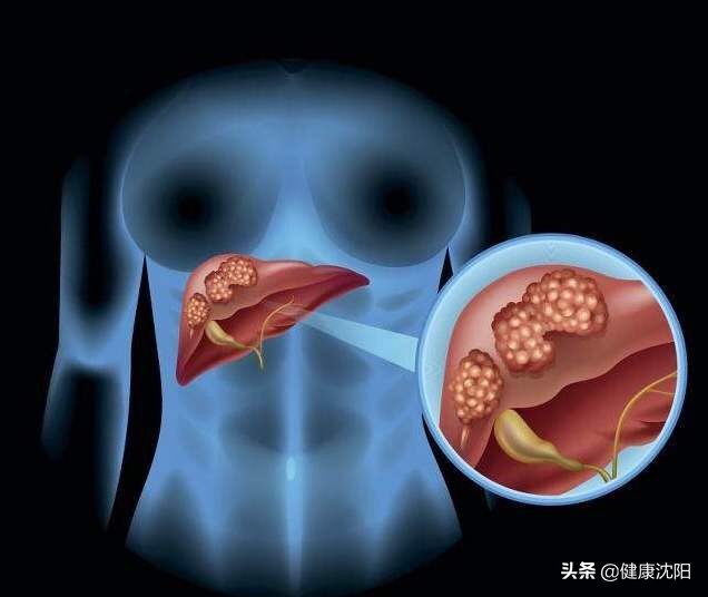 肝癌防治日,世界肝炎日聚焦肝癌治疗新手段
