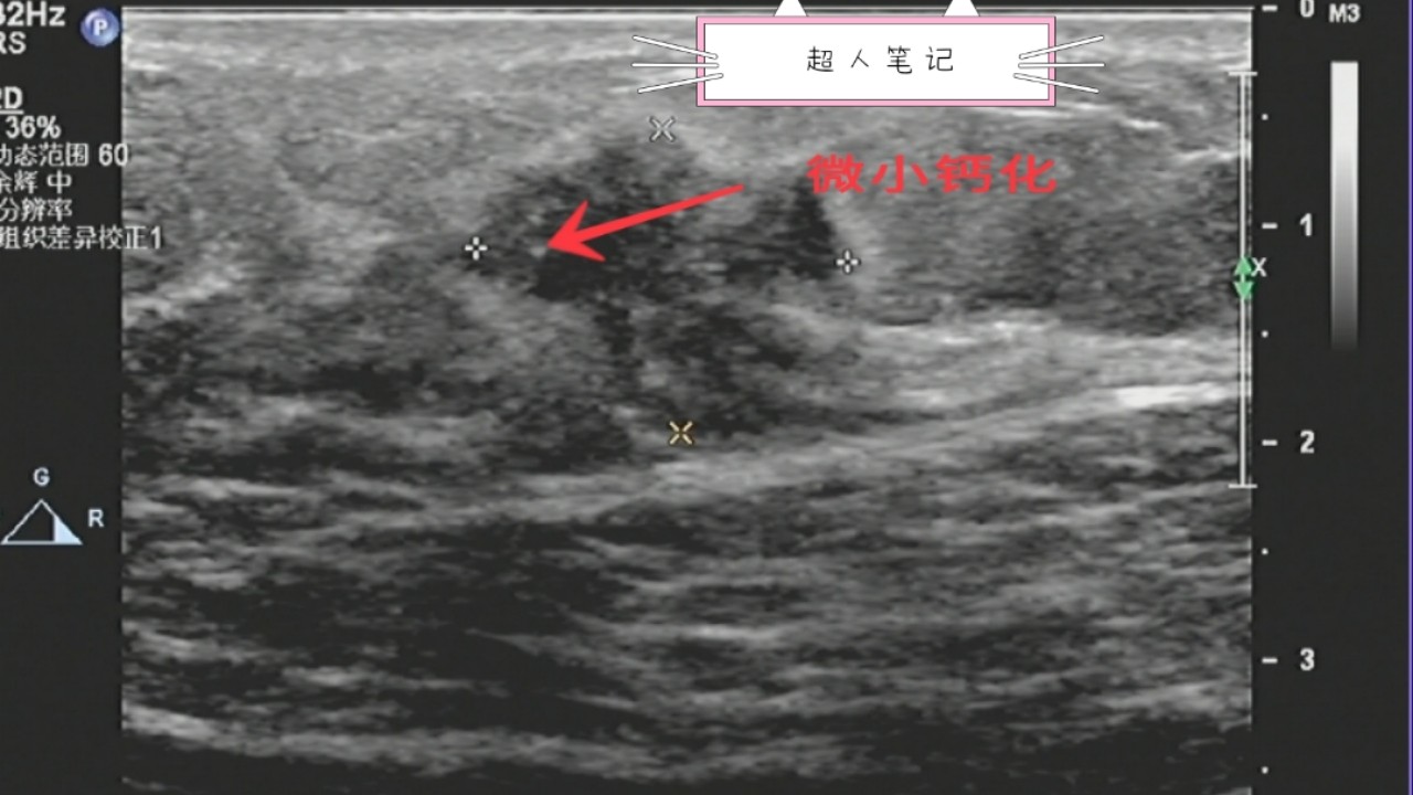 乳腺癌彩超能看出淋巴异常吗,乳腺结节和乳腺癌彩超区别