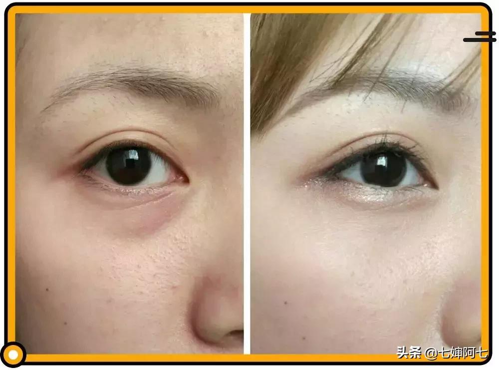 长久都无法消除的黑眼圈,顽固性的黑眼圈要怎么去