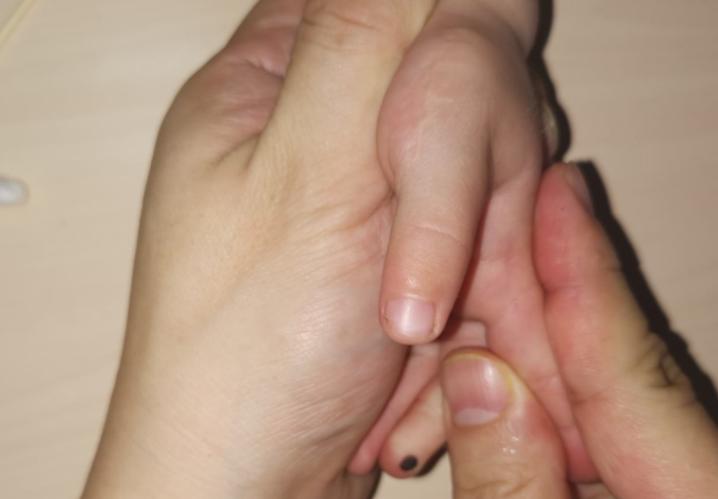 漂浮拇：告捷保五指|案例5《左手多指右手漂浮拇，拇指告捷搬家》