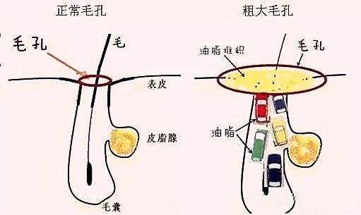 毛孔粗大什么护肤品能改善,毛孔粗大用什么护肤品能够修复