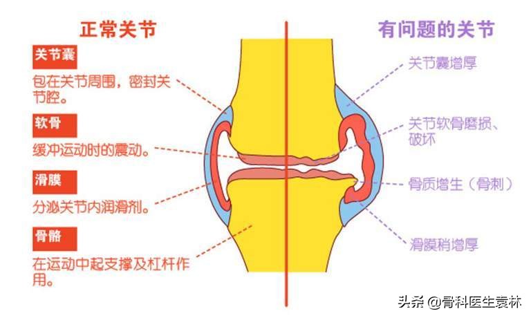 膝关节退行性病变怎么治_膝关节退行性病变该如何治疗