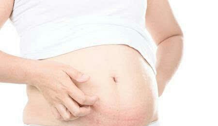 孕期肚皮痒抹什么能够缓解,孕期肚子痒有什么办法能够解决