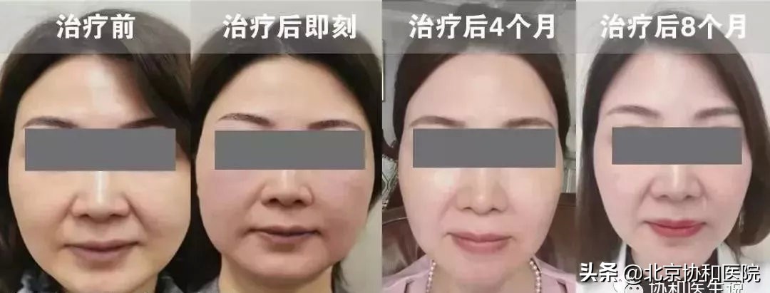 40岁的女人整形手术,40岁女性合适的身体整形医美项目