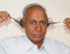 米诺地尔有什么副功能吗,米诺地尔副功能和禁忌