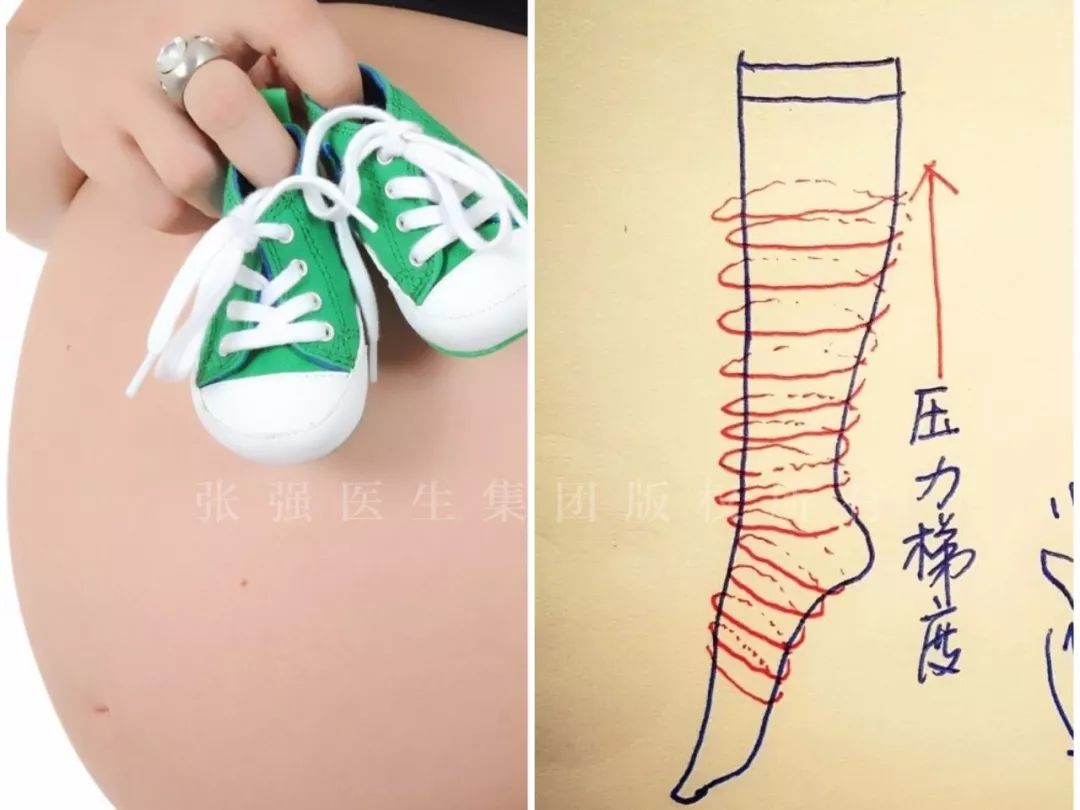 「鼠年“鼠你好孕”」做到这3点，让你轻松应对孕期下肢静脉曲张