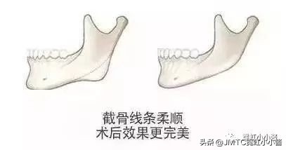 日本小姐姐针灸瘦脸视频,小姐姐打瘦脸针视频