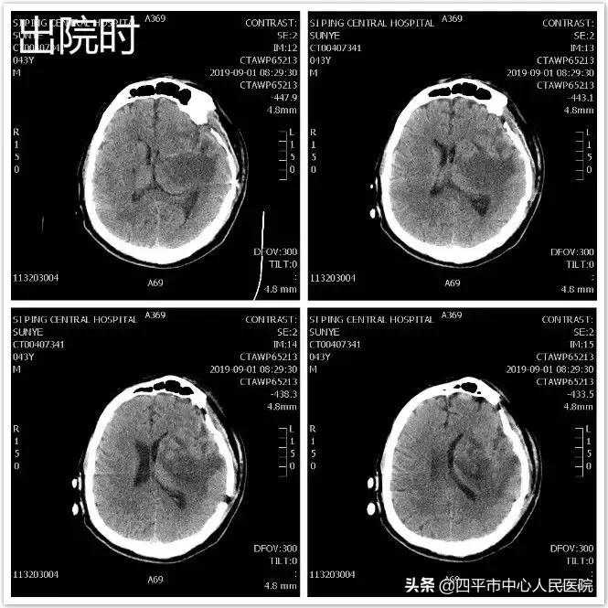 精准排雷再现新高—神经外科在6月份告捷救治6例颅内动脉瘤患者