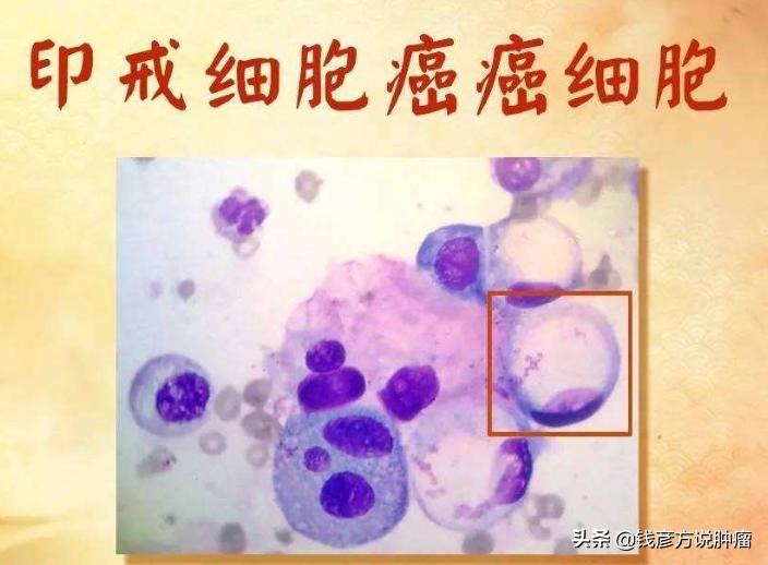 胃印戒细胞癌做手术后还会复发么,胃印戒细胞癌早期没化疗能够吗