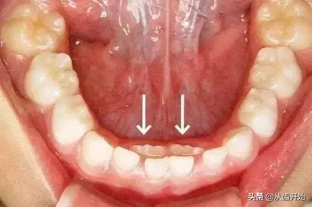 孩子换牙期间怎么做牙齿整齐,孩子换牙期一定要知道四个忠告