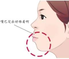 男人龅牙嘴突,龅牙导致的嘴凸怎么拯救