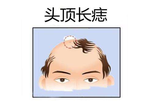 点痣需要注意面相吗,点痣风水学上哪些痣是好的
