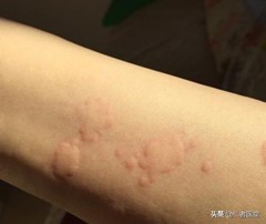 季节性慢性荨麻疹怎么治才能去根,得了慢性麻疹要用什么药