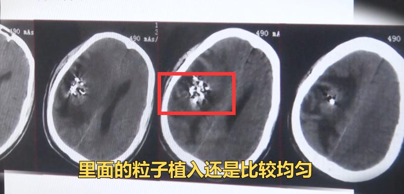 肺癌转移到脑癌死前3个月症状,48岁女子肺癌晚期死亡